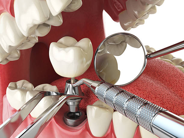 Best Knocked-Out Tooth (Avulsed Tooth) Treatment in Mount Pleasant, PA